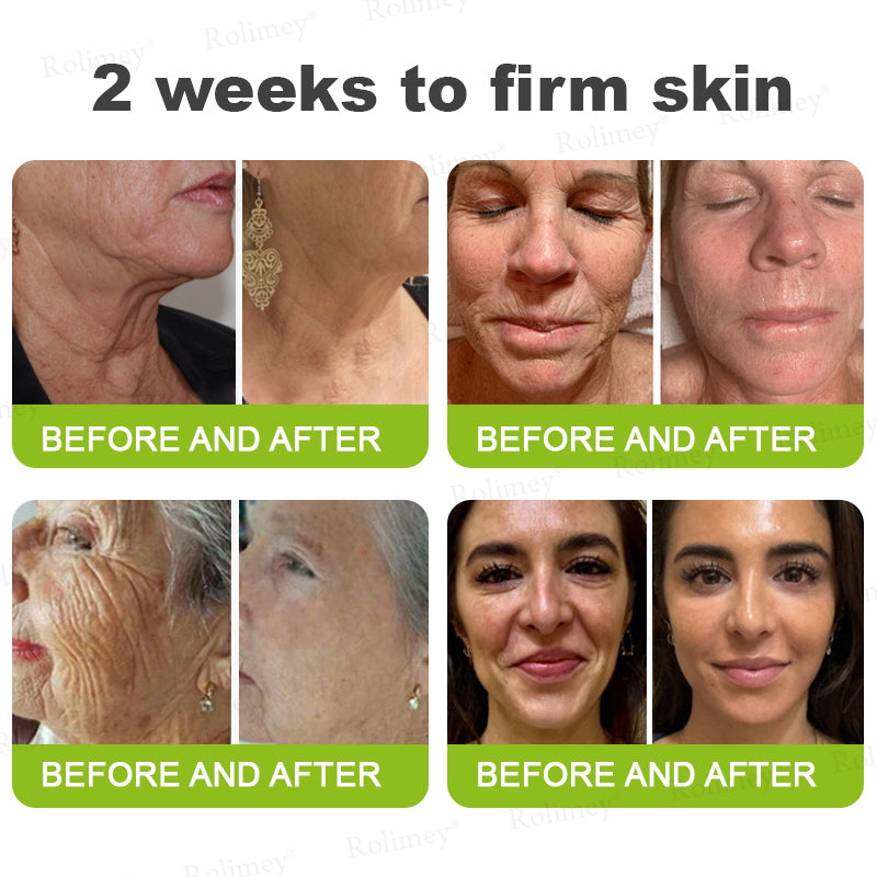 ✨✅👨‍⚕️Made and shipped from the UK 💫Rolimey® Botox & Vita-A Retinol Shot Wrinkle-Lift Tightening cream - Last Day Promotion 70% OFF