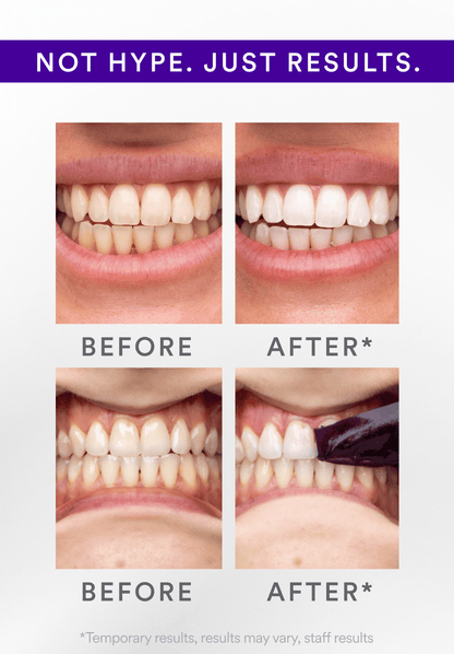 Whitening Strips