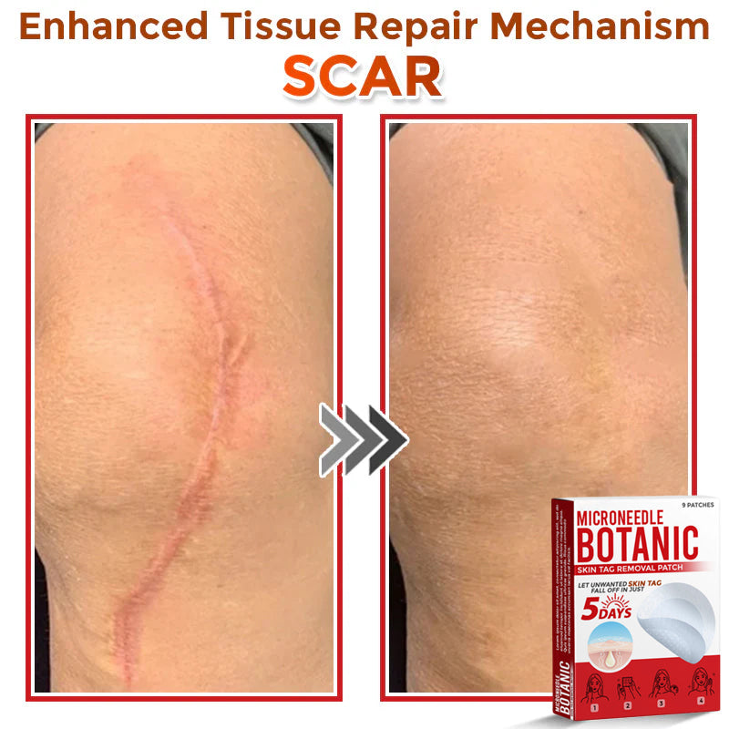 MicroNeedle Botanic Skin Tag Removal Patch 🇺🇸 Made in the USA