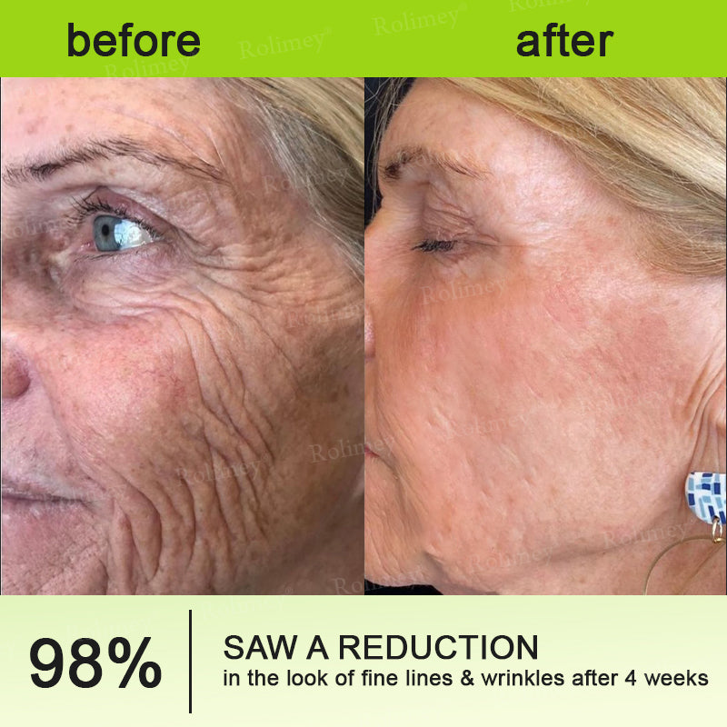 ✨✅👨‍⚕️Made and shipped from the UK 💫Rolimey® Botox & Vita-A Retinol Shot Wrinkle-Lift Tightening cream - Last Day Promotion 70% OFF