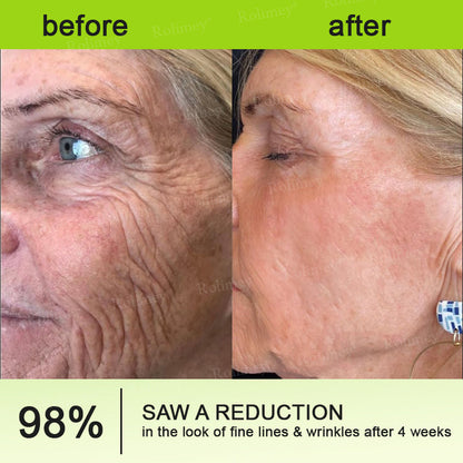 ✨✅👨‍⚕️Made and shipped from the UK 💫Rolimey® Botox & Vita-A Retinol Shot Wrinkle-Lift Tightening cream - Last Day Promotion 70% OFF