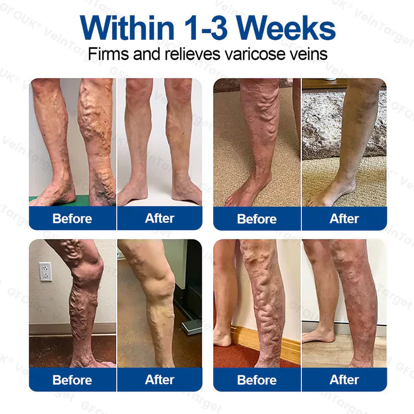 🇦🇺💧👩‍🔬GFOUK® VeinTarget Microneedle Patch⚡Instant Relief, Long-Term Results