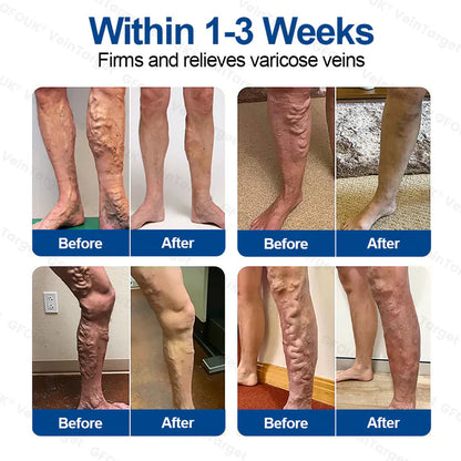 🇦🇺💧👩‍🔬GFOUK® VeinTarget Microneedle Patch⚡Instant Relief, Long-Term Results