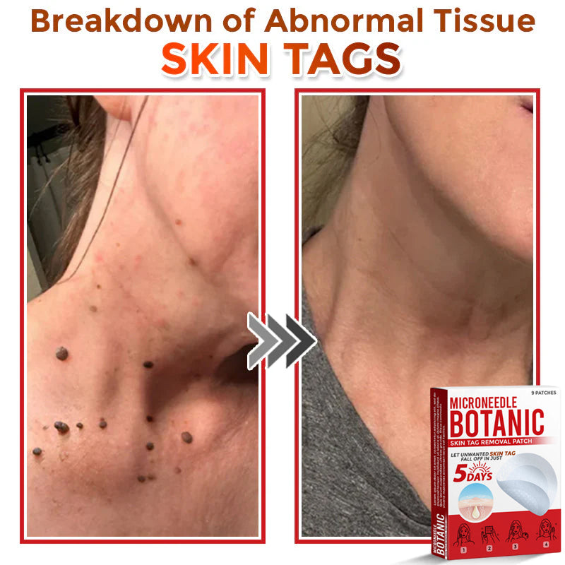 MicroNeedle Botanic Skin Tag Removal Patch 🇺🇸 Made in the USA