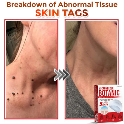 MicroNeedle Botanic Skin Tag Removal Patch 🇺🇸 Made in the USA
