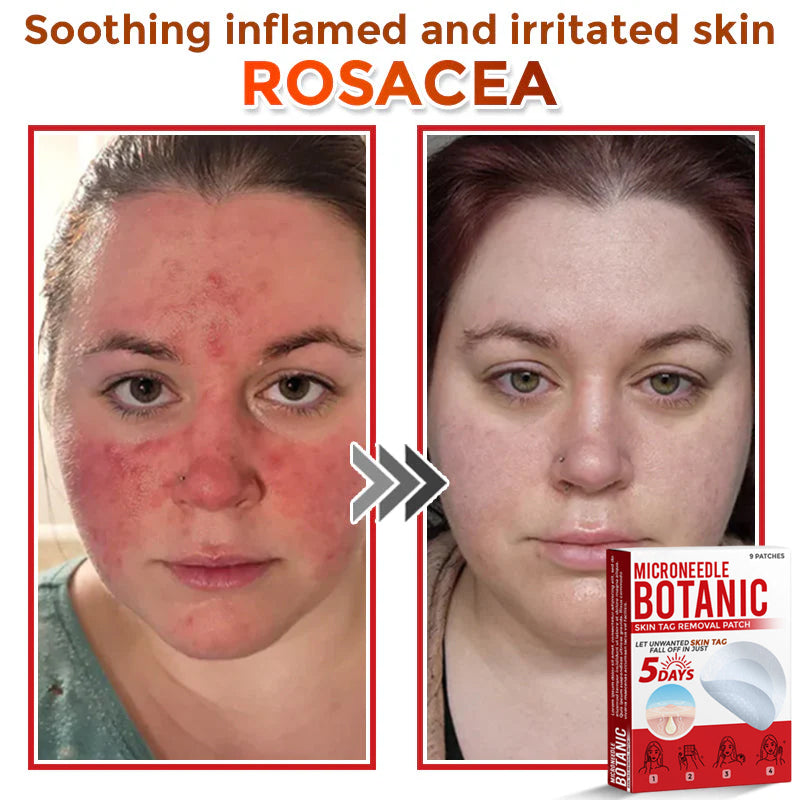 MicroNeedle Botanic Skin Tag Removal Patch 🇺🇸 Made in the USA