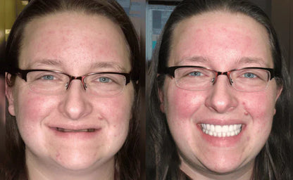Custom-Fit Functional Dentures