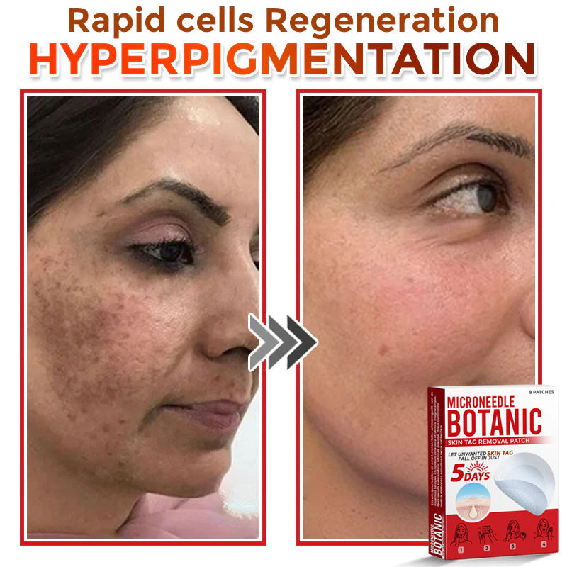 MicroNeedle Botanic Skin Tag Removal Patch 🇺🇸 Made in the USA