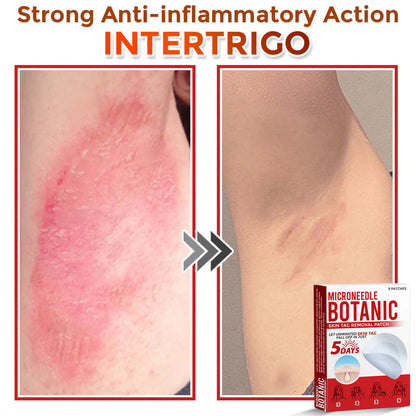 MicroNeedle Botanic Skin Tag Removal Patch 🇺🇸 Made in the USA