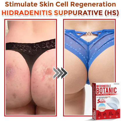 MicroNeedle Botanic Skin Tag Removal Patch 🇺🇸 Made in the USA