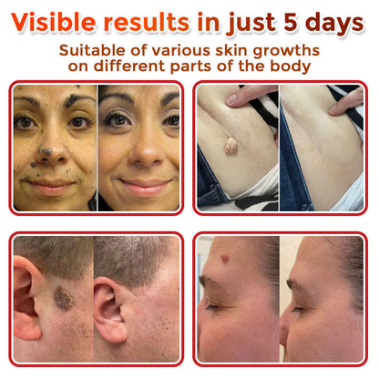 MicroNeedle Botanic Skin Tag Removal Patch 🇺🇸 Made in the USA