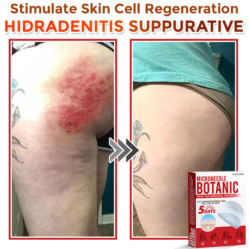 MicroNeedle Botanic Skin Tag Removal Patch 🇺🇸 Made in the USA