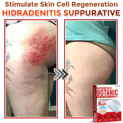 MicroNeedle Botanic Skin Tag Removal Patch 🇺🇸 Made in the USA