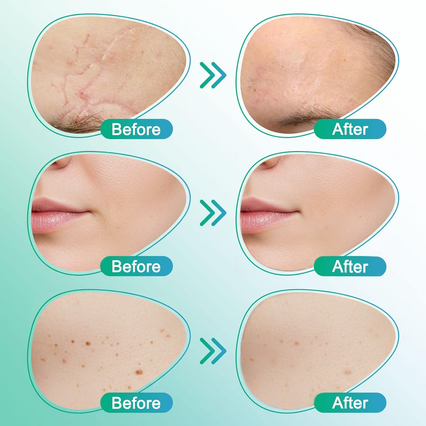 Neslemy™3-in-1 Microneedle Care Patch