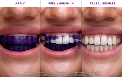 Whitening Strips